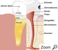 Karies in Schmelz und Dentin